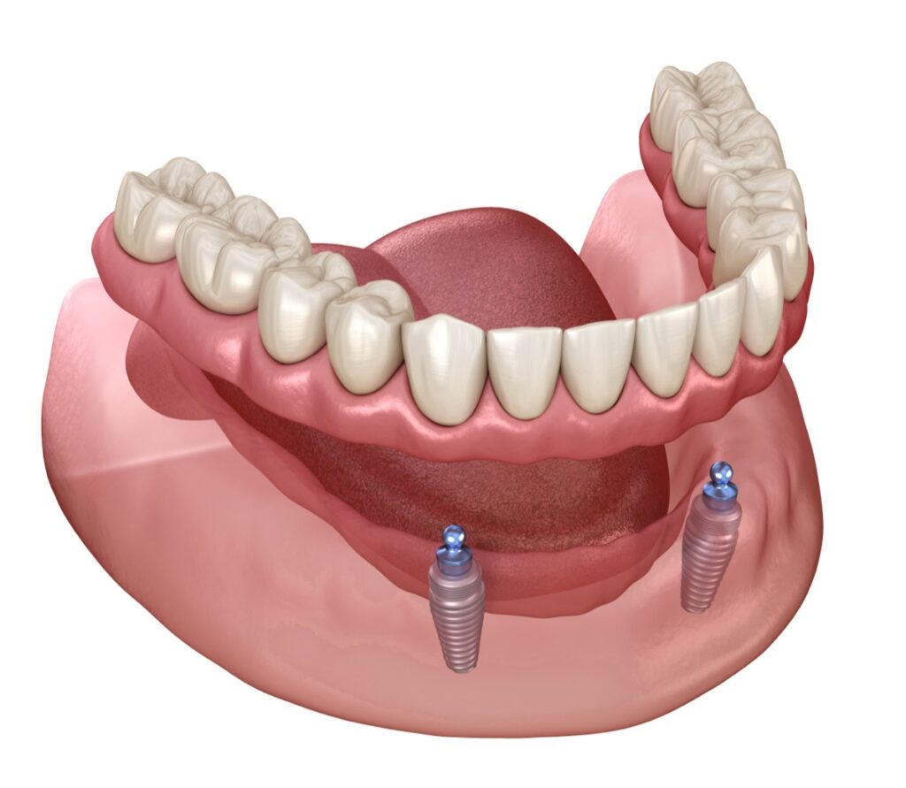 Implant dentures